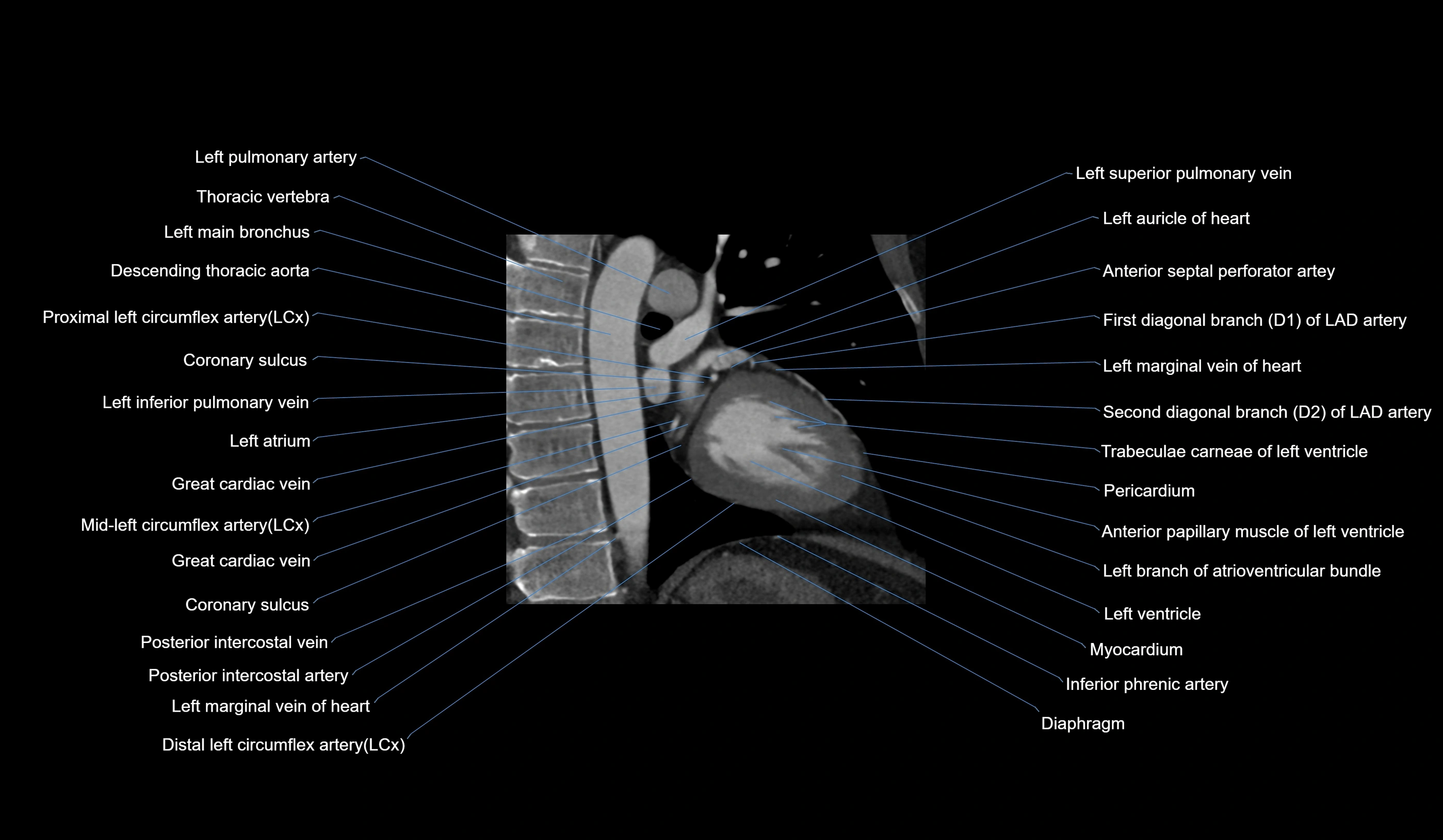 CT heart (coronary angiogram) 2 chamber view cross sectional anatomy labelled radiology image-00008.webp
